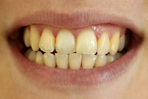 Cùng tìm hiểu đâu là nguyên nhân dẫn tới răng ố vàng?