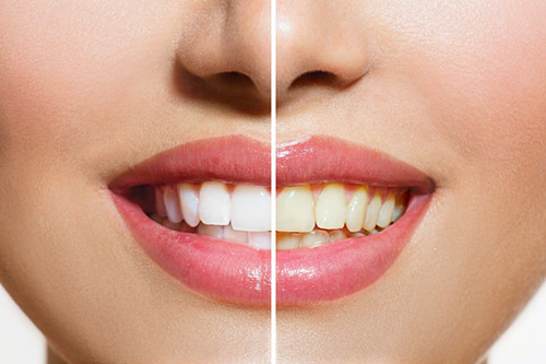 Răng bị ố vàng có thể là do thói quen vệ sinh răng miệng chưa đúng