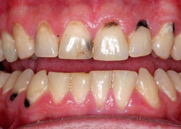 Hình ảnh cho thấy chân răng bị đen