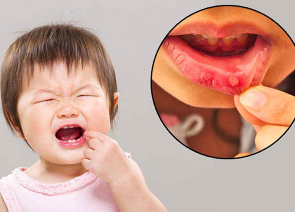 Nhiệt miệng là một bệnh lý thường gặp ở trẻ em