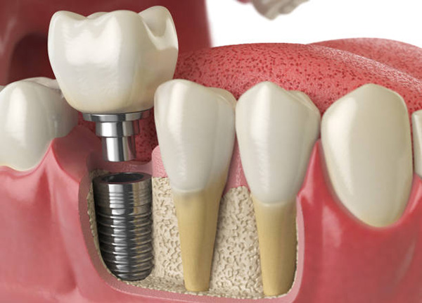 Răng sứ Implant có cấu tạo chặt chẽ với 3 phần như răng thật