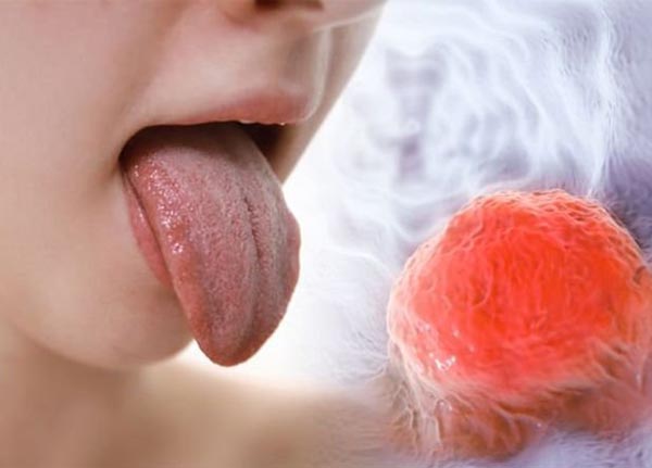 Triệu chứng của ung thư lưỡi khá giống bệnh lý về miệng thông thường