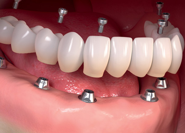Trồng răng giả Implant