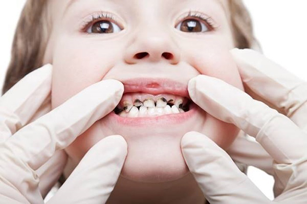 Bệnh răng miệng ở trẻ em và giải pháp phòng ngừa