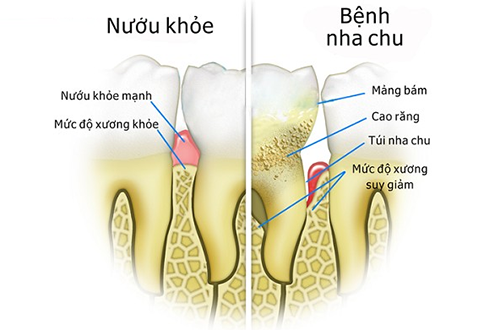 Bệnh nha chu - kẻ thù của sức khỏe răng miệng