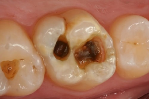 Bóc trần nguyên nhân bệnh sâu răng ở người lớn