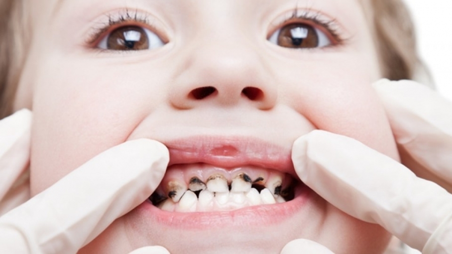 Bệnh sâu răng ảnh hưởng đến thẩm mỹ và ăn uống, sinh hoạt