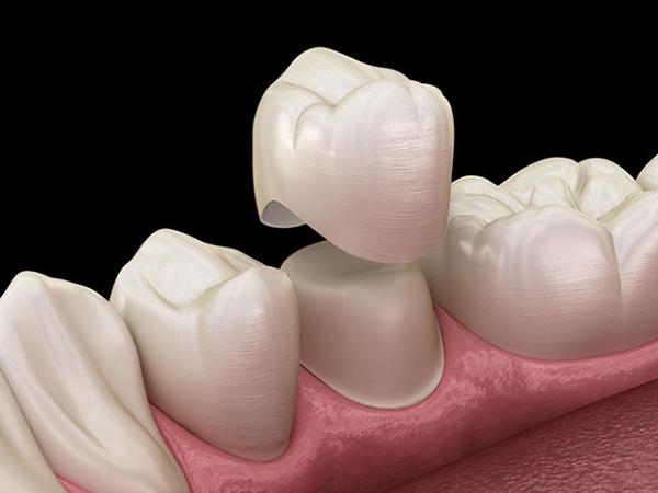 Bọc răng sứ được sử dụng để che đi các khuyết điểm của răng
