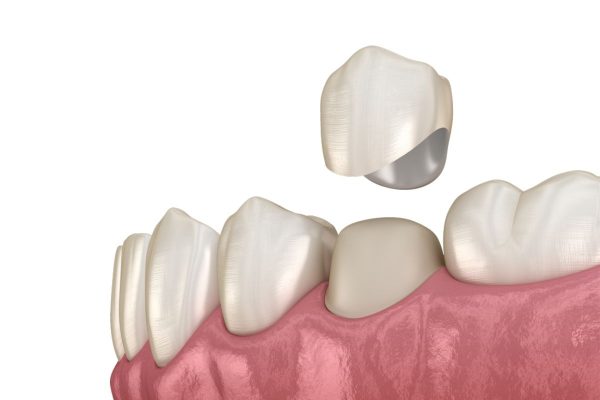 Bọc răng sứ là quá trình bọc một lớp vỏ sứ mỏng lên bề mặt của răng tự nhiên