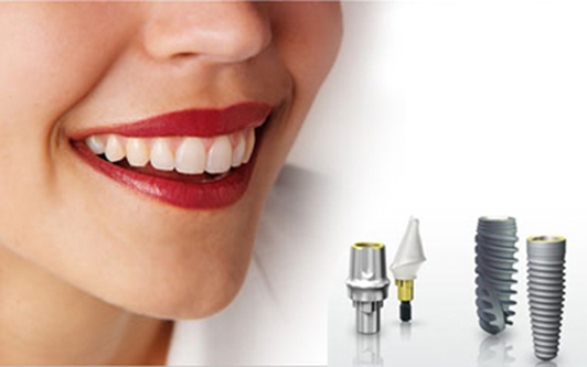 Công nghệ cấy ghép răng Implant