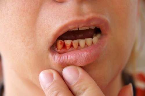 Nướu bị chảy máu khi đánh răng có thể là dấu hiệu mắc bệnh viêm nha chu