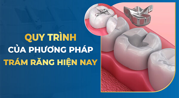 Những sai sót thường gặp và cách khắc phục khi thực hiện kỹ thuật trám răng