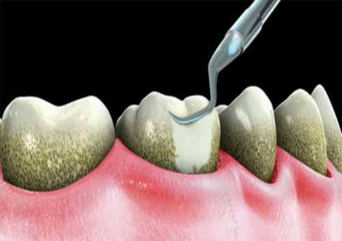 Loại bỏ các mảng bám trên răng