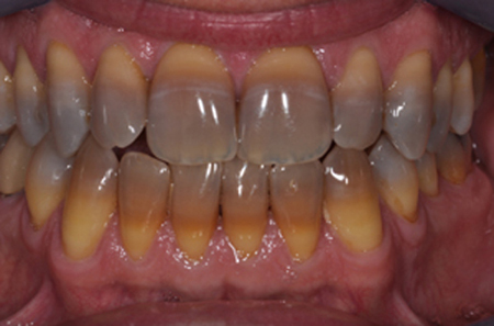  Vì sao răng nhiễm Tetracycline lại không tẩy trắng răng được?