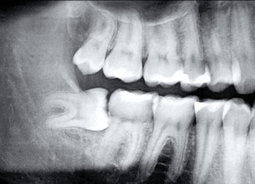 Mọc răng khôn còn là nguyên nhân hủy hoại xương và răngMọc răng khôn còn là nguyên nhân hủy hoại xương và răng