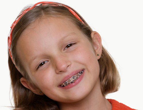 Cần niềng răng cho trẻ từ sớm