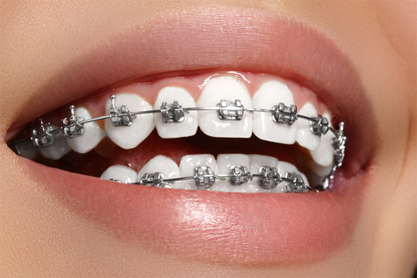 Các phương pháp niềng răng và lưu ý khi chăm sóc