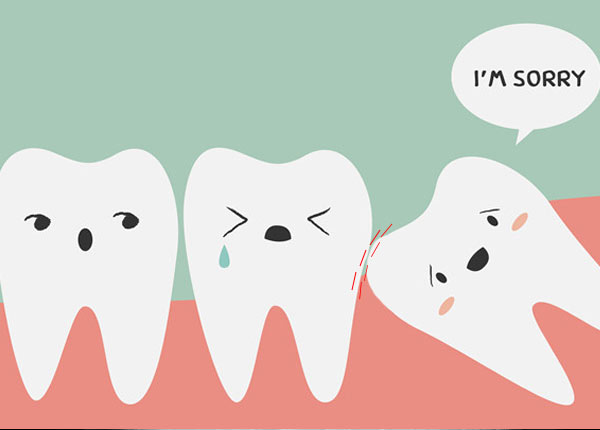 Răng khôn mọc lệch ảnh hưởng đến những răng kế bên