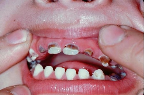 Hàm răng của trẻ mọc không đều