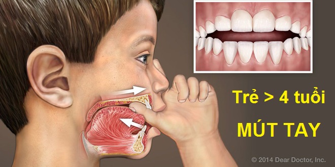 Trẻ mút trong thời gian dài có thể ảnh hưởng đến hình dáng của khoang miệng