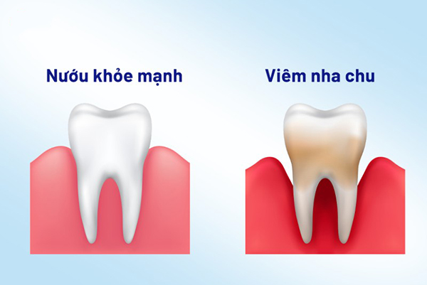 Sự khác biệt giữa răng khỏe mạnh và răng bị viêm nha chu