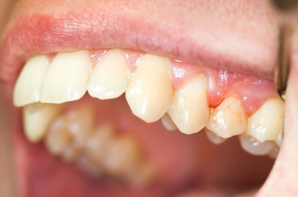 Dấu hiệu của bệnh răng miệng