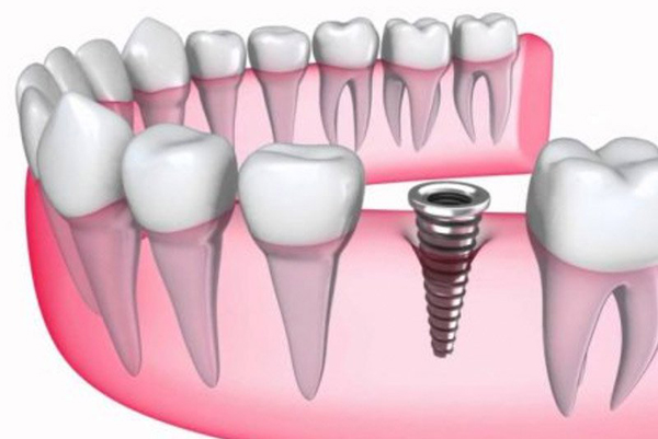 Lựa chọn loại răng sứ phù hợp trước khi thực hiện trồng răng sứ