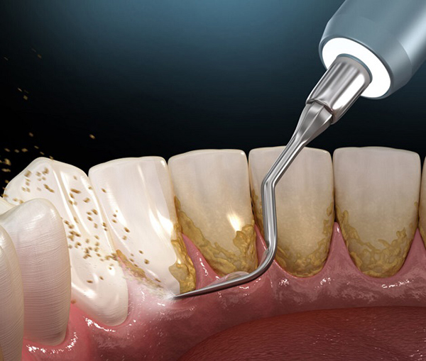Lợi ích của việc lấy cao răng định kỳ và giải pháp hạn chế hình thành cao răng