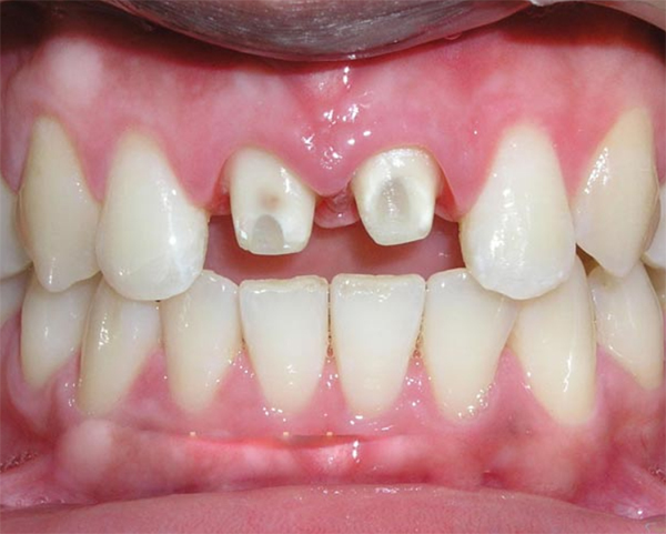 Răng sứ thường được sử dụng để sửa chữa răng bị hỏng, bị nứt, hoặc mất đi