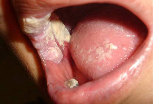 Bệnh nấm miệng trẻ em rất dễ mắc phải