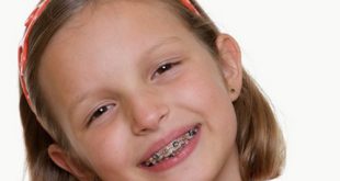 Cần niềng răng cho trẻ từ sớm