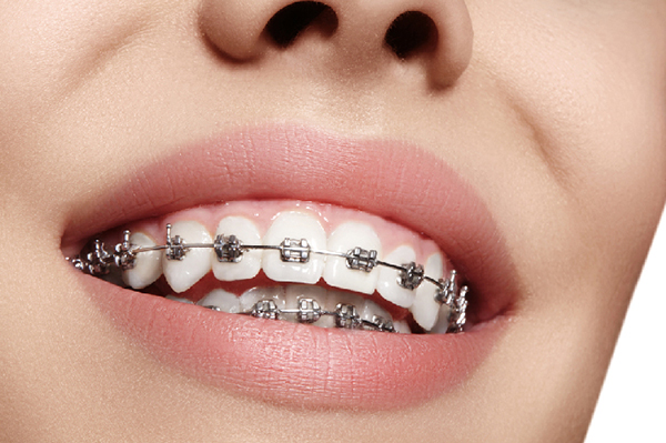 Niềng răng là quá trình cải thiện sự thẳng hàng và sắp xếp chúng một cách đều đặn