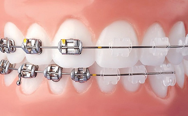 Thời gian niềng răng còn phụ thuộc vào phương pháp niềng răng