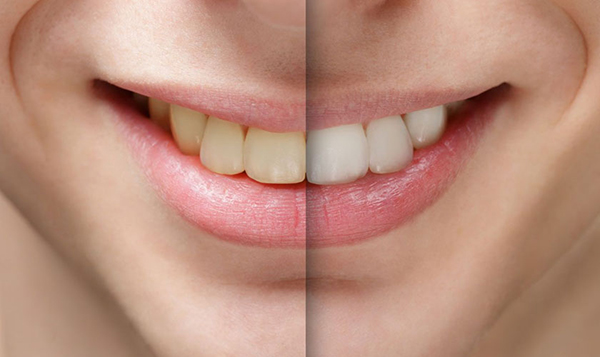 Răng bị xỉn màu cảnh báo tình trạng sức khỏe răng miệng