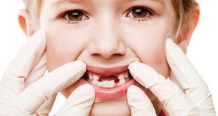 Bệnh Sâu răng ở trẻ em