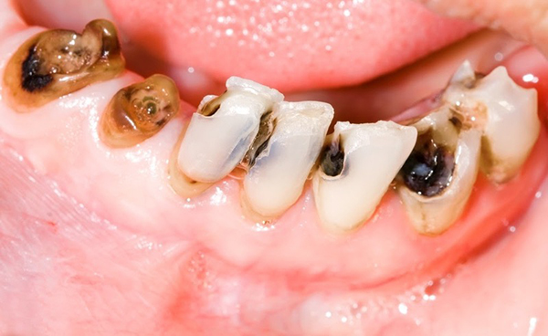 Bệnh sâu răng gây ra những hậu quả khó lường