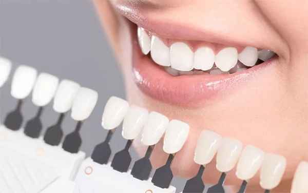 Quy trình tẩy trắng răng và cách duy trì hàm răng trắng khỏe