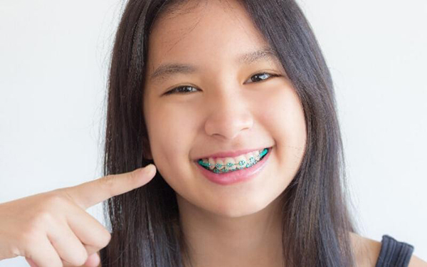Tuổi thanh thiếu niên là độ tuổi thích hợp để niềng răng