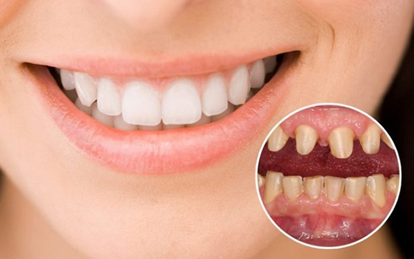 Thời điểm trồng răng sứ tùy thuộc vào tình trạng sức khỏe răng, cơ xương hàm,...