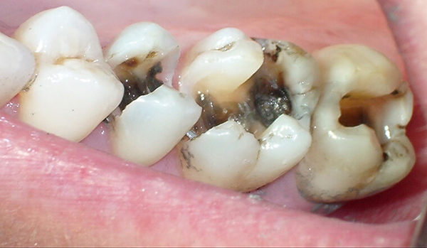Tình trạng sâu răng phổ biến