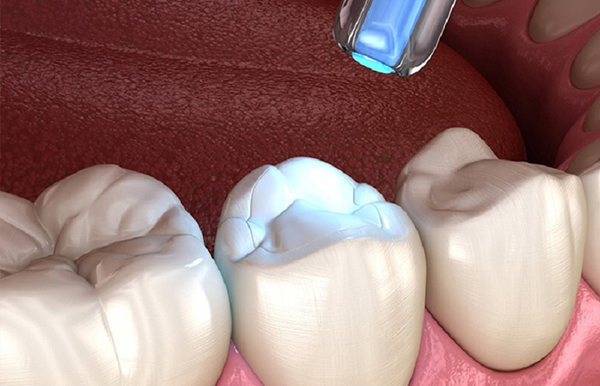 Trám răng thẩm mỹ cần được thực hiện bởi những nha sĩ có chuyên môn, vật liệu an toàn