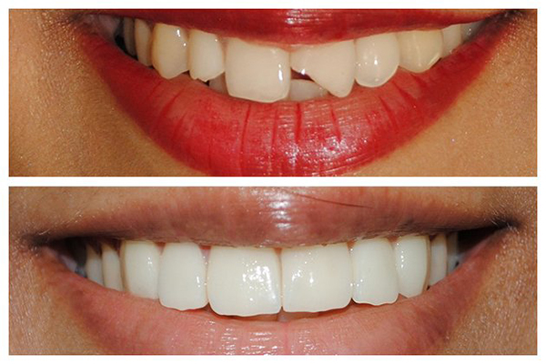 Trám răng có khả năng phục hình chức năng và thẩm mỹ