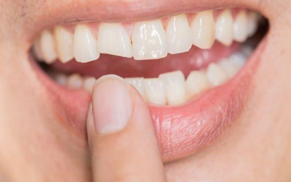 Người có răng bị biến dạng hoặc không đều có thể trám răng thẩm mỹ để giúp hàm răng đều đặn