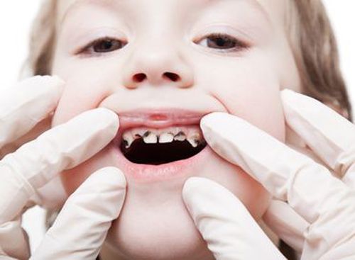 Trẻ bị đau răng do sâu hoặc viêm nướu