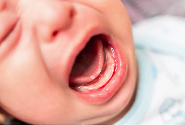 Trẻ sơ sinh có thể trải qua một số vấn đề răng miệng phổ biến