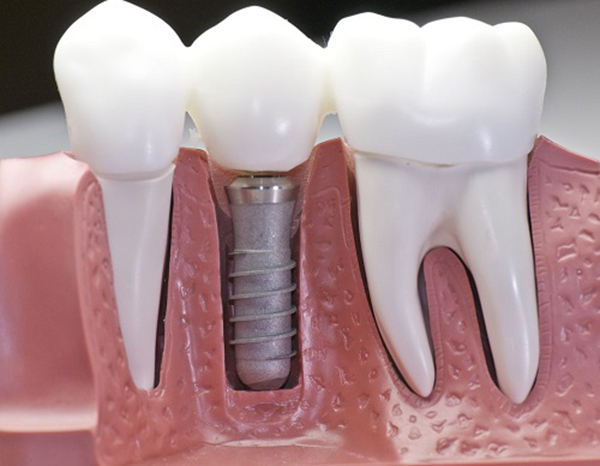 Trồng răng sứ được áp dụng trong trường hợp mất răng